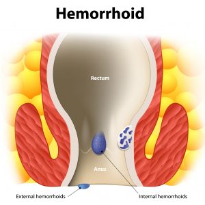 How to Know If You Have Hemorrhoids and the Cure to Pruritus Ani